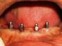 All-on-Four Dental Implants Benefits  Dr Bharat Agravat Dental Implants Screw Denture India